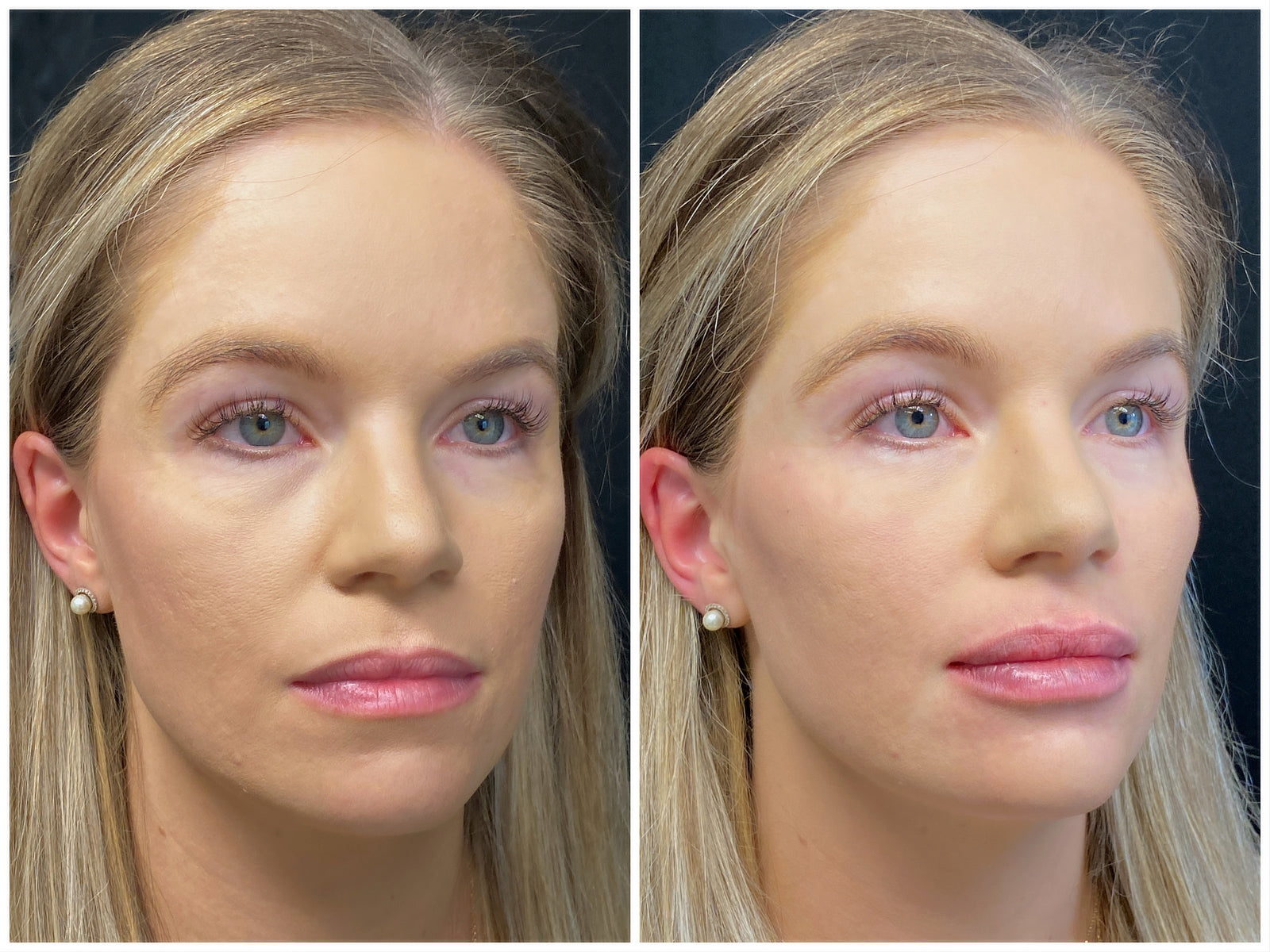 Sun damage & uneven tone — full face