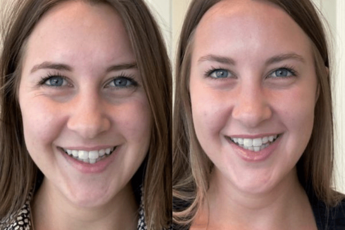 Sun damage & uneven tone — full face