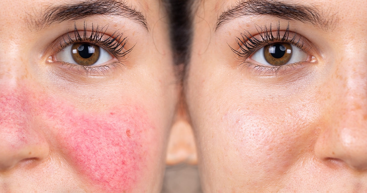 Redness & Rosacea