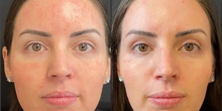 Sun damage & uneven tone — full face