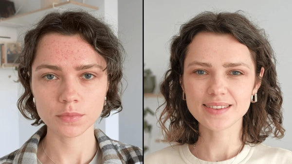 Acne & Acne Scars